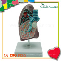 Pädagogische Demonstrationserkrankung Lunge Anatomisches Modell